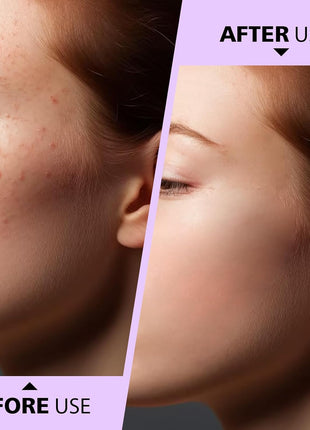 Stainless Steel Acne-Blackhead Removal Stick Tool